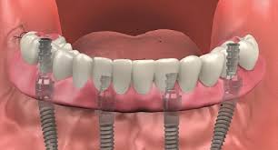 what are full mouth dental implants and
