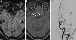 a patient with acute ischemic stroke