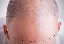 Gillette erkekler için kafa tıraşı ipuçlarını sunar: Sac Ekimi Sonrasi Dikkat Edilmesi Gereken 12 Sey Sac Bakimi