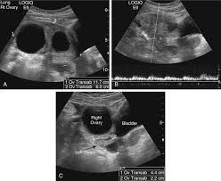 Is a 3.4 cm ovarian cyst big? Ovarian Mass Radiology Key