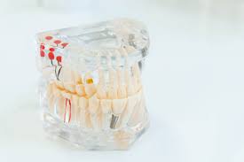 the steps for a dental implant procedure