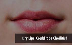 dry lips could it be cheilitis