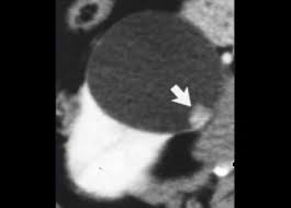 The Radiology Assistant Kidney Cystic Masses