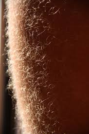 In alopecia areata which is an autoimmune condition there is loss of hair on the legs also. Leg Hair Wikipedia