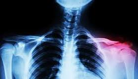 Image result for icd 10 code for displaced left midshaft clavicle fracture