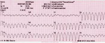 Paroxysmal supraventricular tachycardia (psvt) is a type of abnormal heart rhythm, or arrhythmia. Paroxysmal Supraventricular Tachycardia Psvt