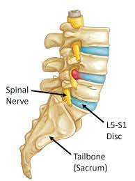 treating an l5 s1 disc herniation a