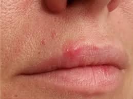 cold sore treatment and canker sore