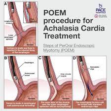 poem for achalasia cardia treatment in