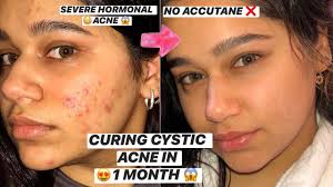 accutane acne skincare