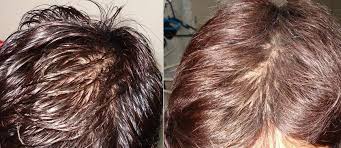 Resultado de imagem para thinning hair
