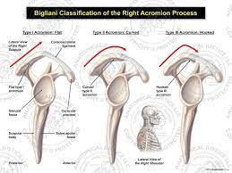 Case contributed by dr sajoscha sorrentino. Bigliani Classification Of The Right Acromion Process In 2021 Acromioclavicular Joint Classification Impingement