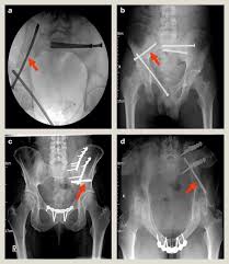 Each hemi pelvis bone comprises 3 bones the ilium white pubis orange and ischium blue the 3 bones. Radiography Anatomy And Imaging In Pelvic Fractures Sciencedirect