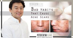 5 bad habits that can cause acne scars