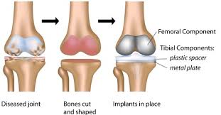 how many types of knee implants are