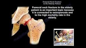 fem neck fracture in the elderly