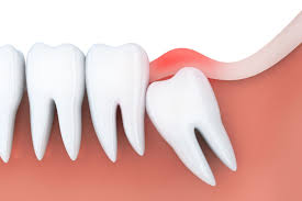 the wisdom tooth removal process in