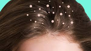 what causes dandruff the truth behind