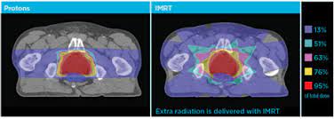 proton therapy myth 3 proton bob