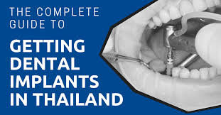 Some insurance plans do cover portions of dental implants. The Complete Guide To Getting Dental Implants In Thailand