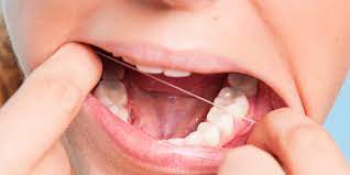 Once removed, a piece of gauze will be used to help absorb any blood and to apply pressure to the. How To Care For Yourself After Wisdom Teeth Removal Implants Oral Surgery Of Chattanooga