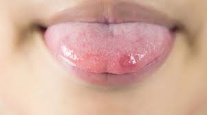early signs of tongue cancer