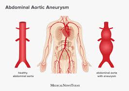 An aneurysm is an outward bulging, likened to a bubble or balloon, caused by a localized, abnormal, weak spot on a blood vessel wall. Abdominal Aortic Aneurysm Screening Treatment And Symptoms