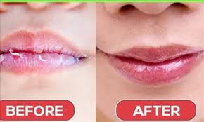 is your lips dried this winter try
