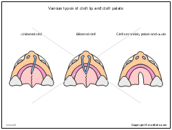 cleft lip and cleft palate ilrations
