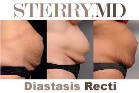 tummy with diastasis recti repair