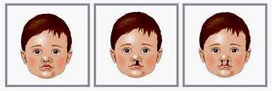 cleft lip and palate cleft information