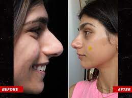 Mia khalifa before nose job