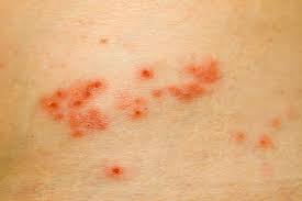 There's also a much higher frequency of asymptomatic shedding of the virus in hsv 2 (genital herpes) then in hsv 1. Genital Pimples Vs Herpes The 1 Source For Alternative Solutions To Heal Thy Self