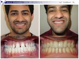 When an appliance won't do the trick, braces probably will. Underbite Correction Without Surgery In Sugar Land And Houston
