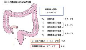 「大腸癌 ステージ」の画像検索結果