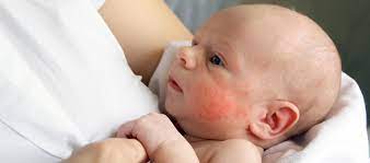 14 types of common baby rashes pers