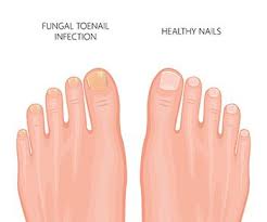 nail fungus treatment best