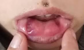 what is nesting with lip piercings