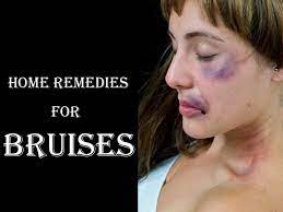 14 best home remes for bruises how