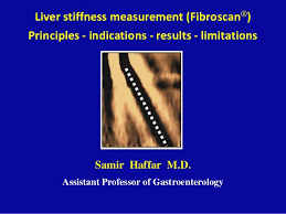 Liver Stiffness Measurement Fibroscan