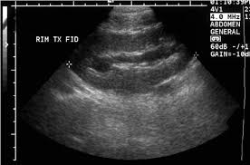 ultrasound with moderate hidronefrosis