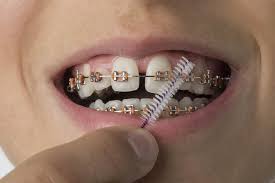 Dental bonding for gaps bonding is a method in which a small gap and chips of teeth are fixed. Gap Teeth What Causes Gaps Between Front Teeth How To Fix It Cost Dentaleh