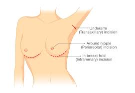 Ultimate Guide To Breast Augmentation