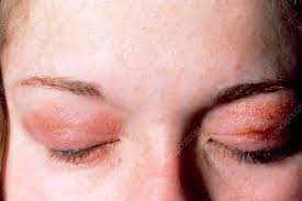 allergic reaction to eye make up