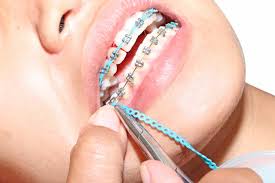 How do you reduce pain from braces? How To Ease Braces Teeth Pain Eagle 93 Missoula S Best Country