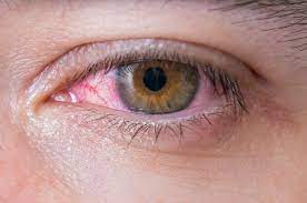 Problems in vision are due to imbalance of the third eye chakra. 5 Home Remedies For Pinkeye