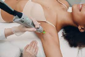 underarm laser hair removal here s
