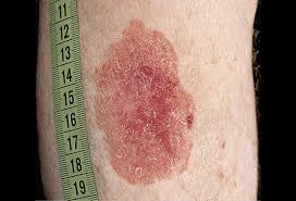 The mutations cause the cells to grow out of control and form a mass of cancer these abnormal moles — which look irregular and are generally larger than normal moles — are more likely than others to become cancerous. Skin Cancer Picture Image On Medicinenet Com
