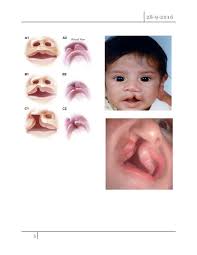 cleft lip and cleft palate pdf د