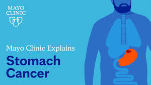 stomach cancer symptoms and causes